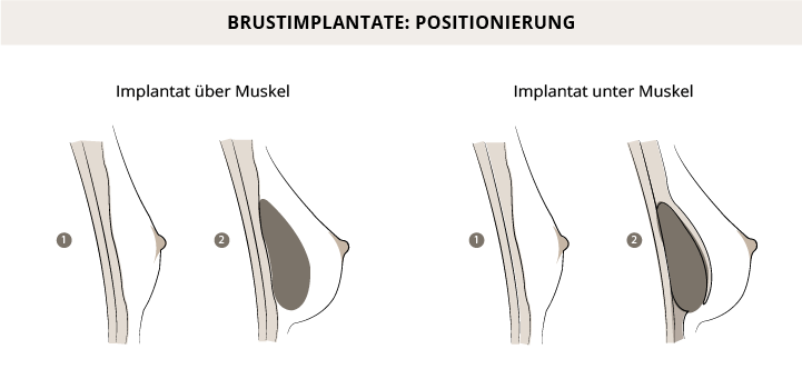 Positionierung Brustimplantate, Klinik am Pelikanplatz, Hannover, Dr. Entezami 