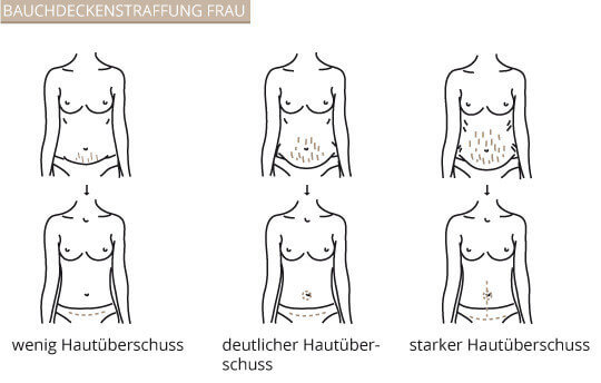 Bauchdeckenstraffung Frau, Klinik am Pelikanplatz, Hannover, Dr. Entezami 