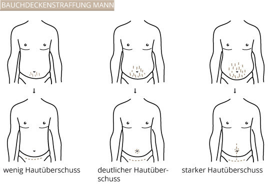 Bauchdeckenstraffung Mann, Klinik am Pelikanplatz, Hannover, Dr. Entezami 