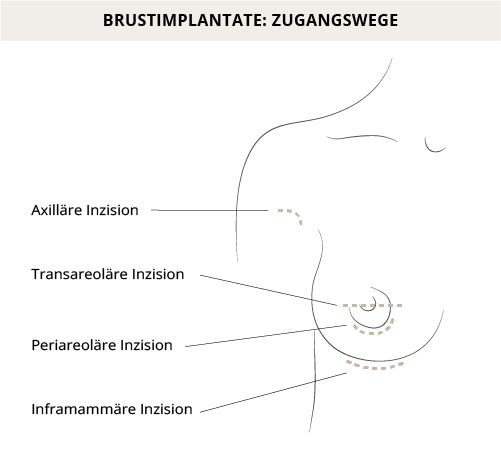 Zugangswege Brustimplantate, Klinik am Pelikanplatz, Hannover, Dr. Entezami 