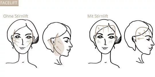 Facelifting, Klinik am Pelikanplatz, Hannover, Dr. Entezami 