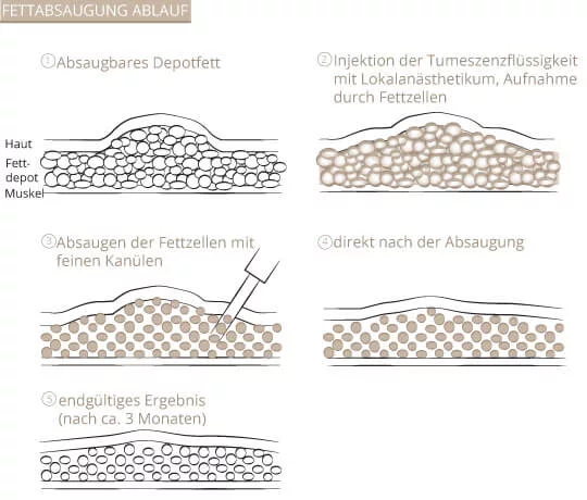 Ablauf Fettabsaugung, Klinik am Pelikanplatz, Hannover, Dr. Entezami 