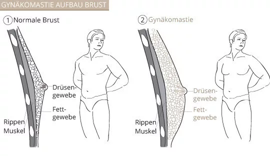 Gynäkomastie, Klinik am Pelikanplatz, Hannover, Dr. Entezami 