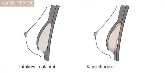 Kapselfibrose, Klinik am Pelikanplatz, Hannover, Dr. Entezami 