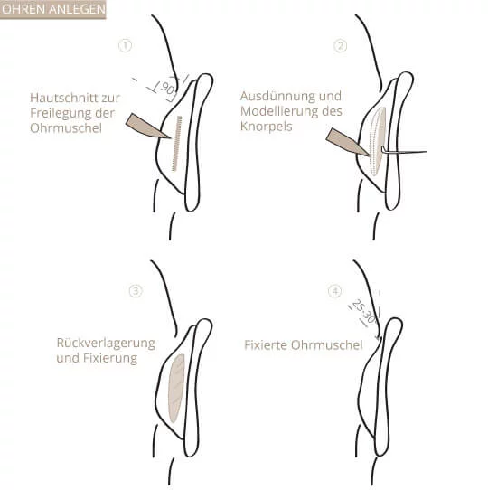 Ohren anlegen, Klinik am Pelikanplatz, Hannover, Dr. Entezami 