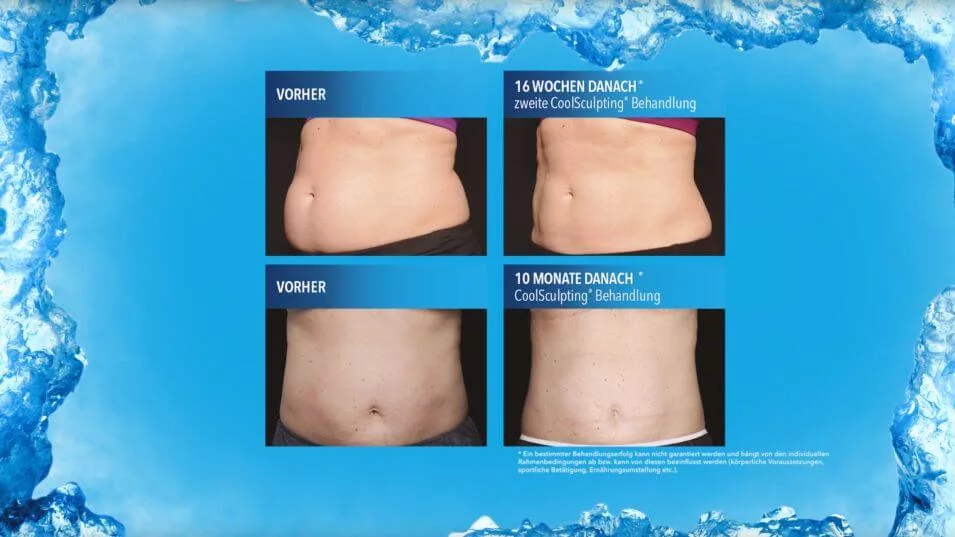 Coolsculpting, Dr. Entezami, Klinik am Pelikanplatz, Hannover, Thumbnail