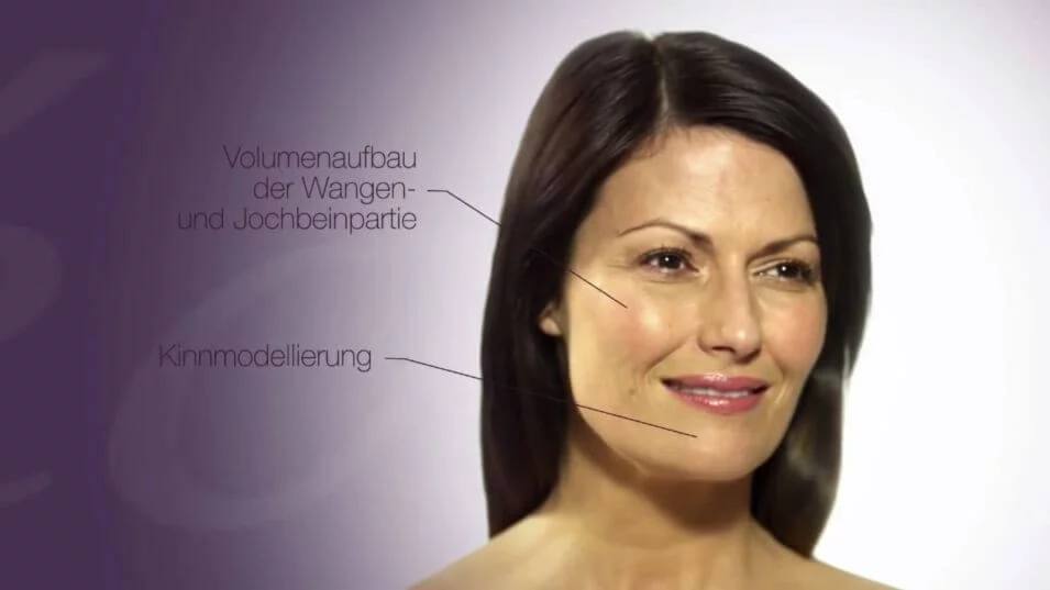 Juvederm, Faltenunterspritzung mit Hyaluronsäure, Dr. Entezami, Klinik am Pelikanplatz, Hannover, Thumbnail